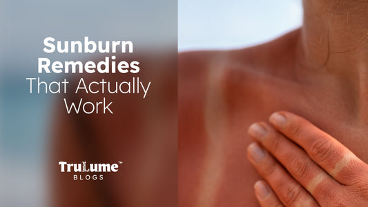 Sunburn Remedies That Actually Work