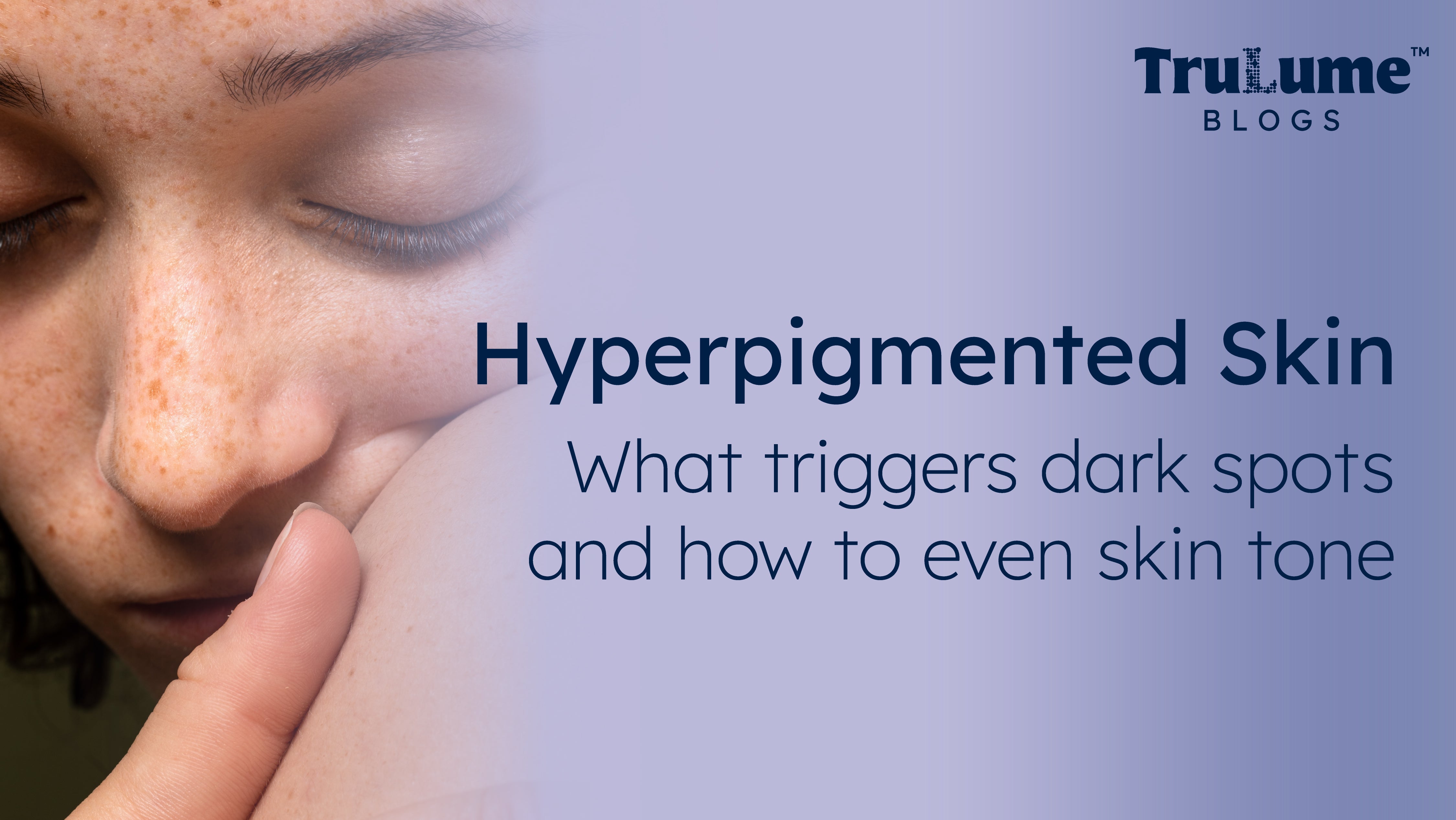 Hyperpigmented Skin & Dark Spots? How To Manage It? – TruLume